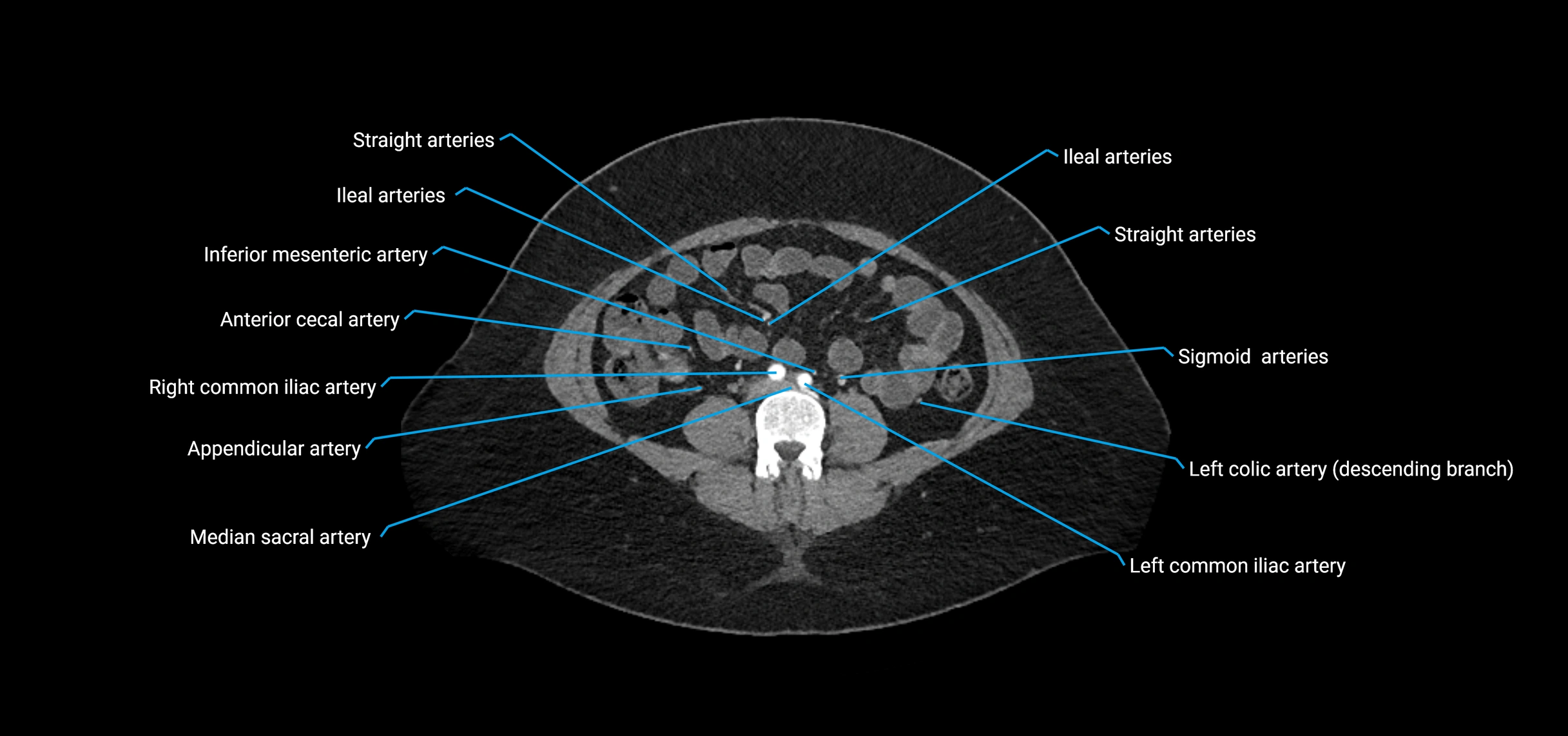 CTA abdomen axial cross sectional anatomy labelled image_136 (2).webp
